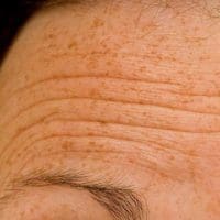 Forehead Lines