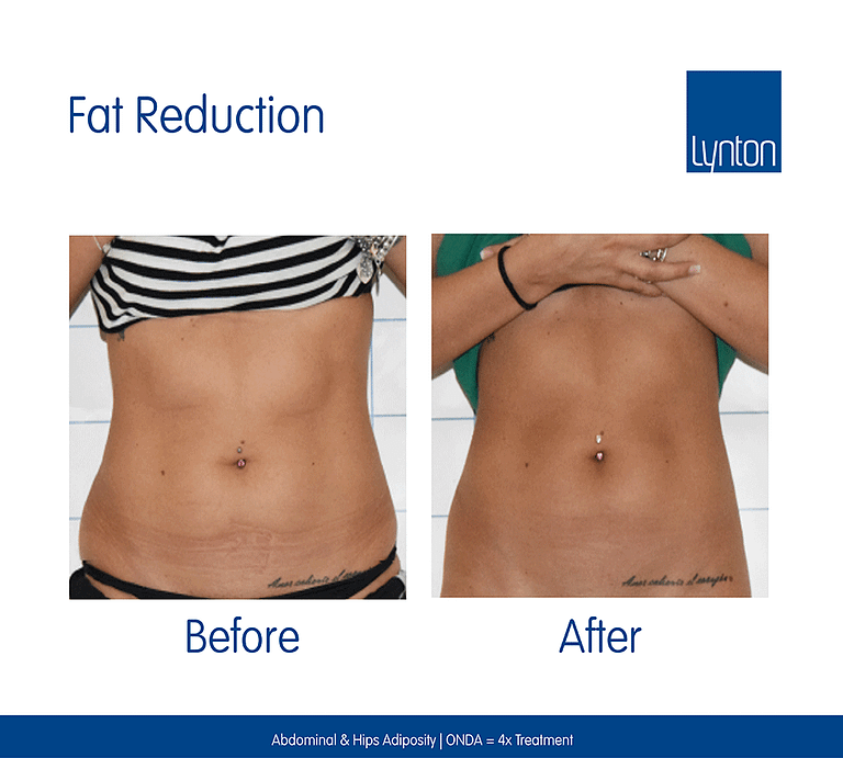 ONDA-Abdominal-4x-Treatments