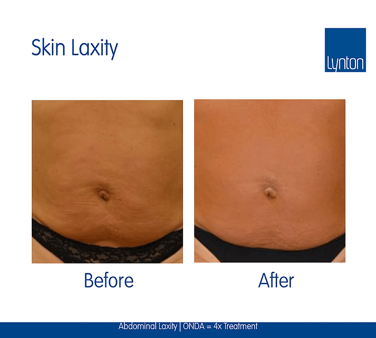 ONDA-Abdominal-Laxity-4x